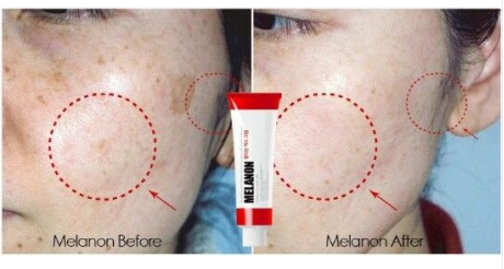 Medi-Peel Melanon X Cream 30 ml Crema tratament pete-pigmentare